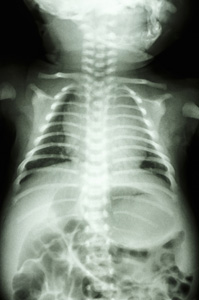 normal chest of infant