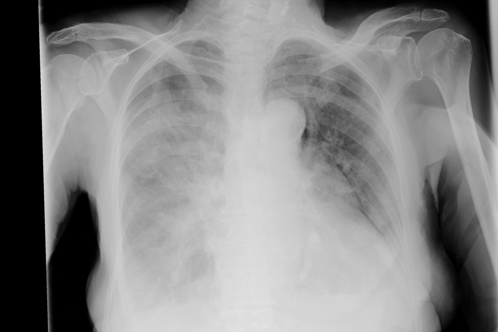 posterior anterior chest x-ray showing signs of infiltration due to pneumonia