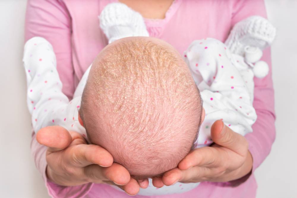 Little newborn baby with psoriasis or dandruff in the hair